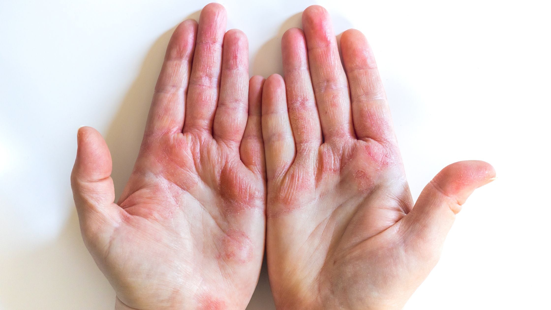 Managing the Struggles of Hand Eczema